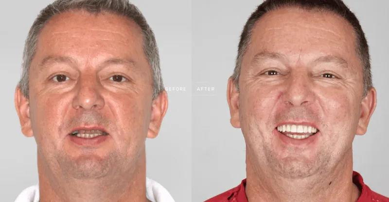 Before and after smile restoration — Patient 1