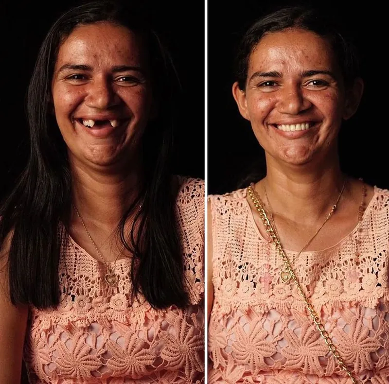 Before and after implant and prosthetic smile — Patient 3